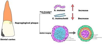 Corynebacterium matruchotii: A Confirmed Calcifying Bacterium With a Potentially Important Role in the Supragingival Plaque